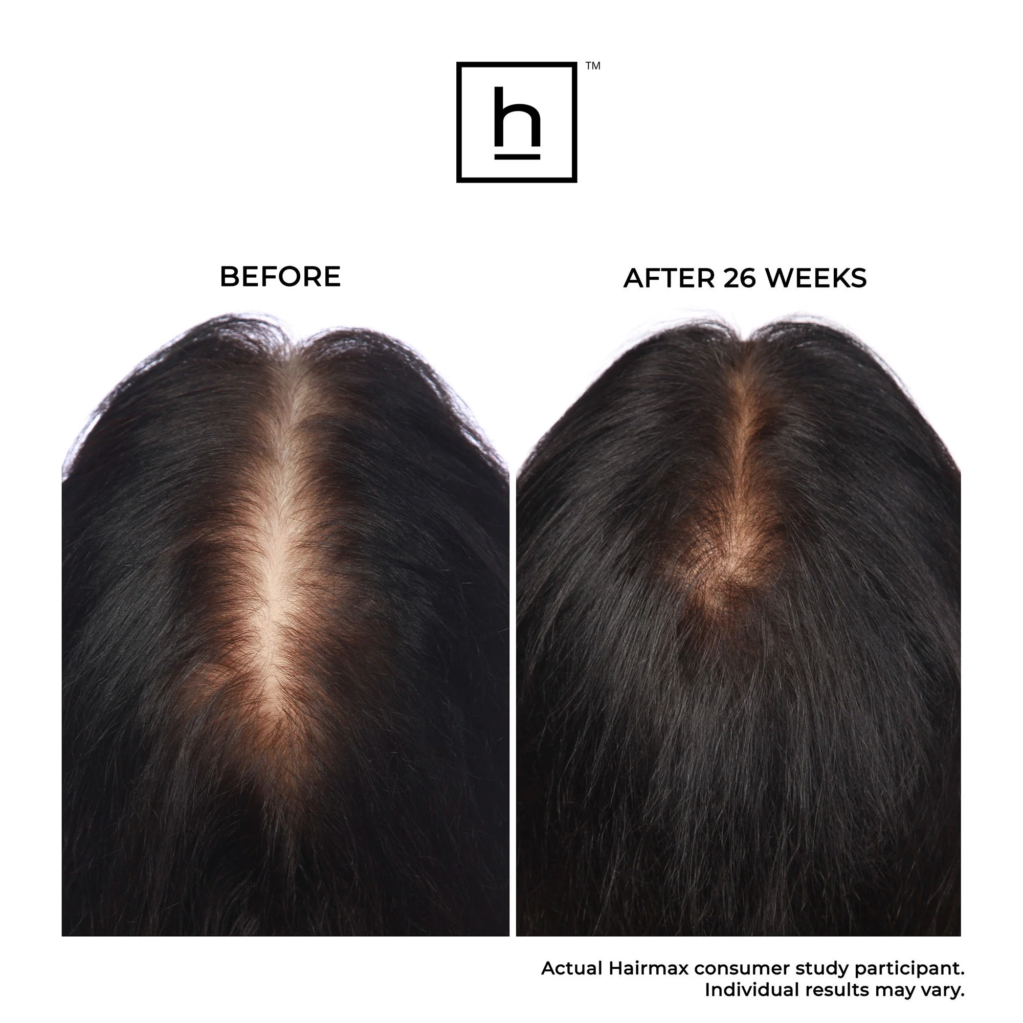 Ultima 12 Hair Growth LaserComb - Image 3