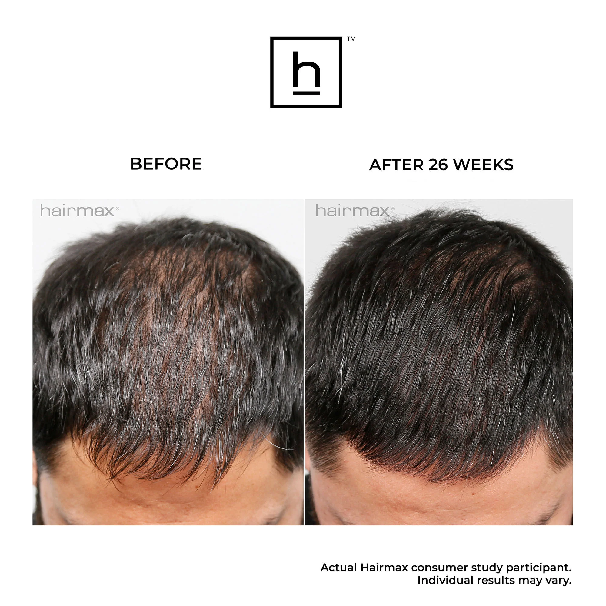 Ultima 12 Hair Growth LaserComb - Image 5