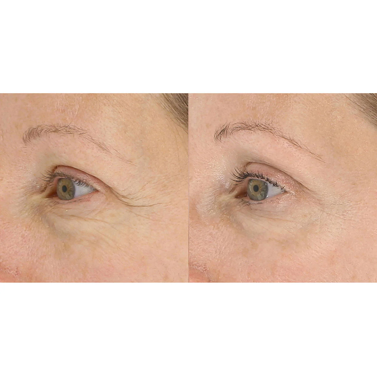 LightStim for Wrinkles - Image 5