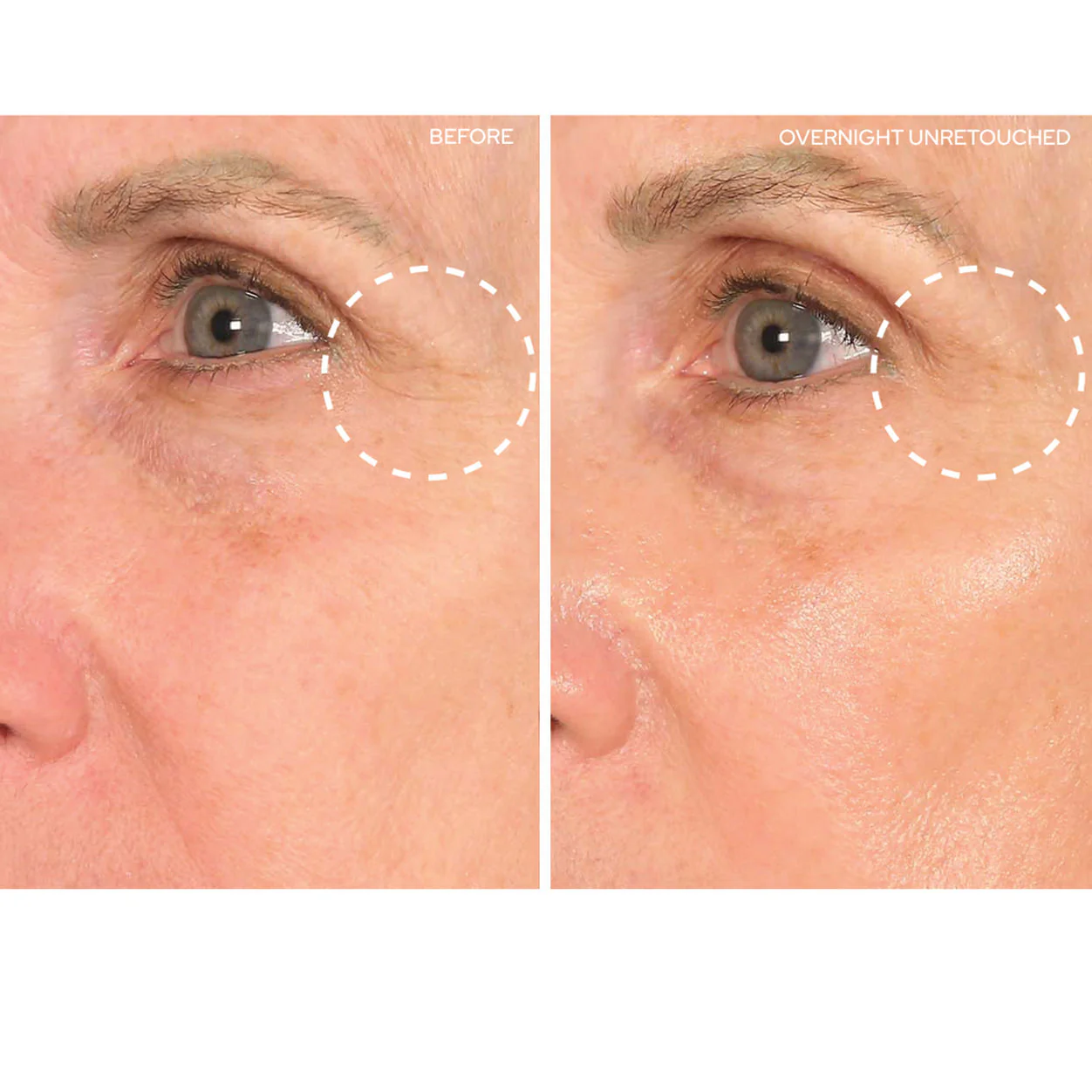 Eye and Smile Lift - Image 2